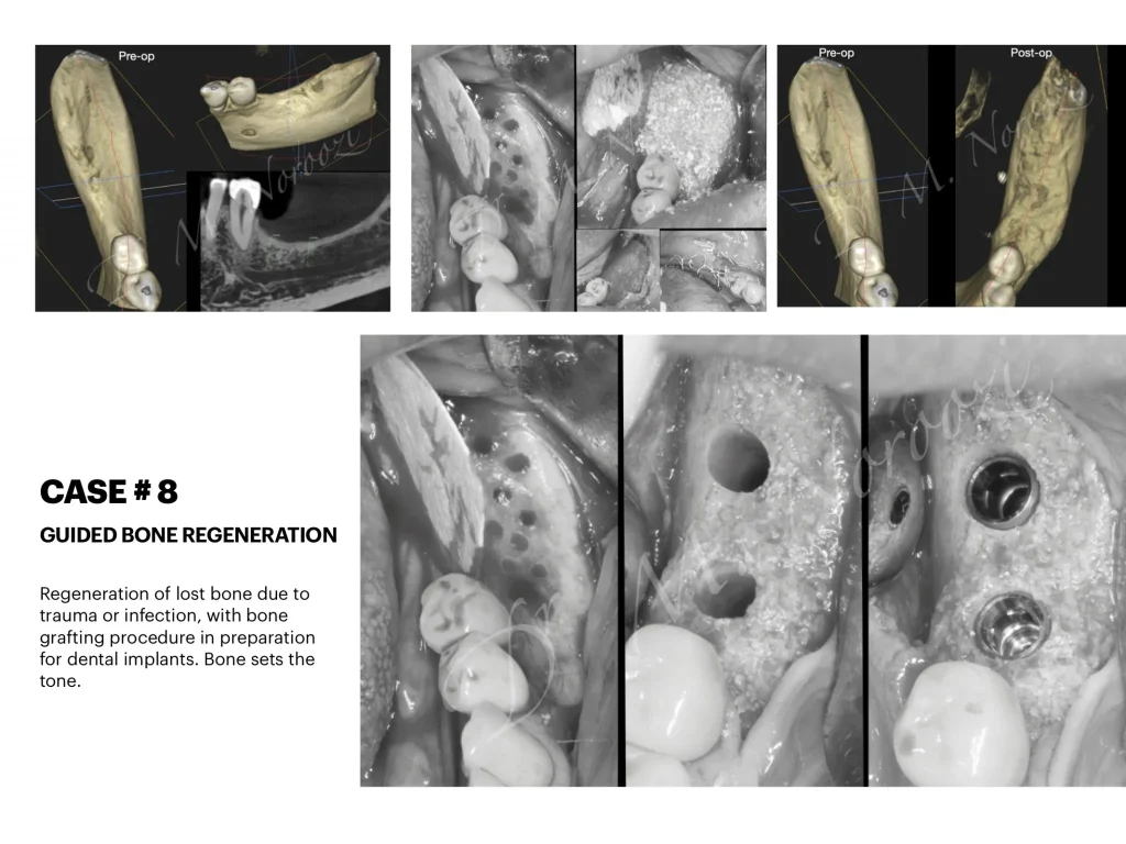 IMPrESS Perio Implant Center Dr. Noroozi Vancouver Periodontist Implant Specialist Burnaby BC