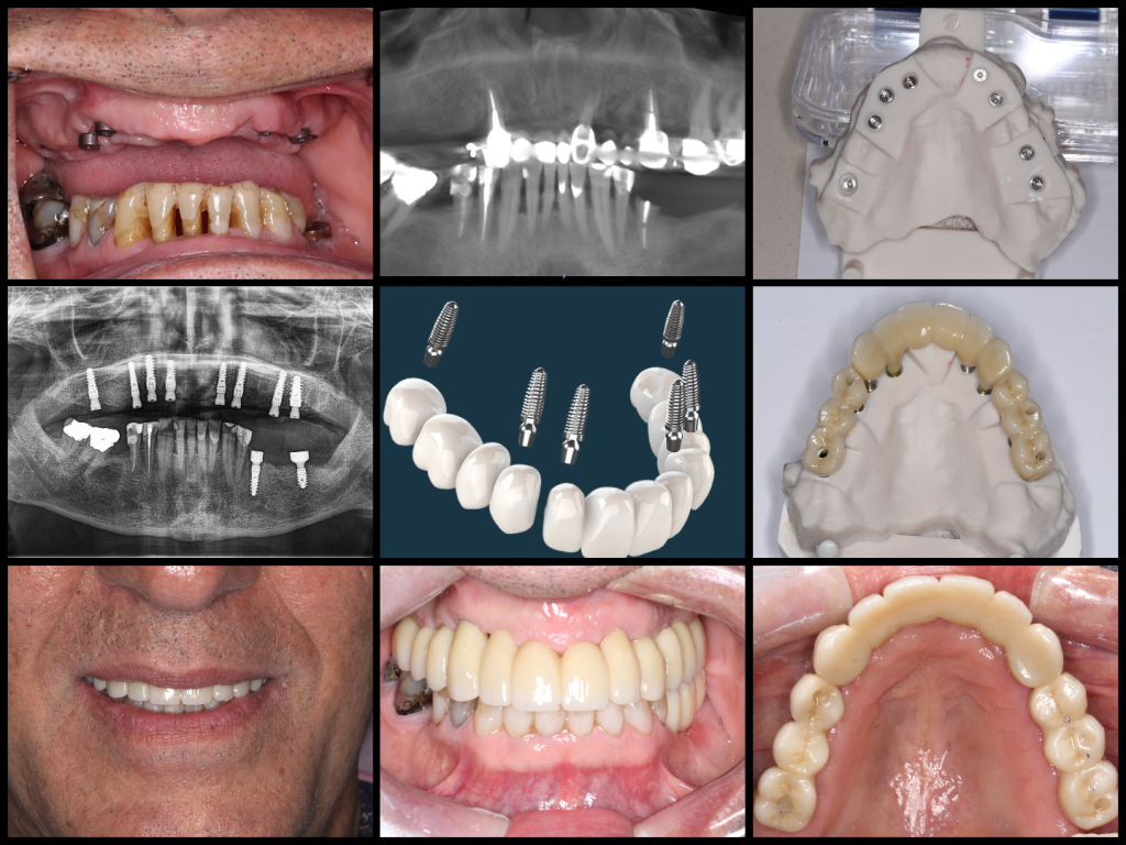 3 on 6 implants Full Mouth Implants IMPrESS Perio Implant Center Dr. M. Noroozi Vancouver Implant Specialist