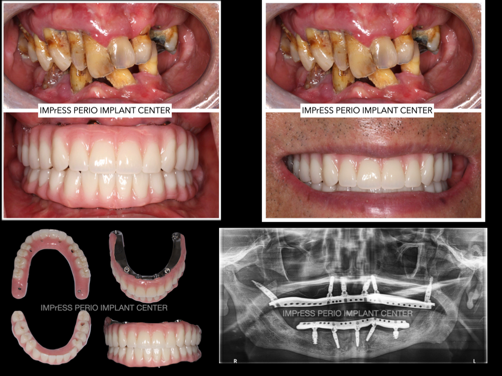 All On X Full Mouth Implants Fixed Teeth IMPrESS Perio Implant Centre Dr Noroozi Burnaby Vancouver BC