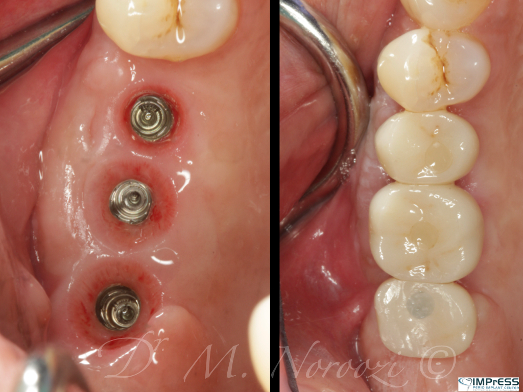 Bone Grafting for implants Guided Implant Surgery Implant Bridge Dr. Noroozi Vancouver Implant Specialist IMPrESS Perio Implant Center