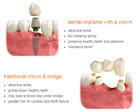 Dental Implant IMPrESS Perio Implant Center Periodontist Burnaby
