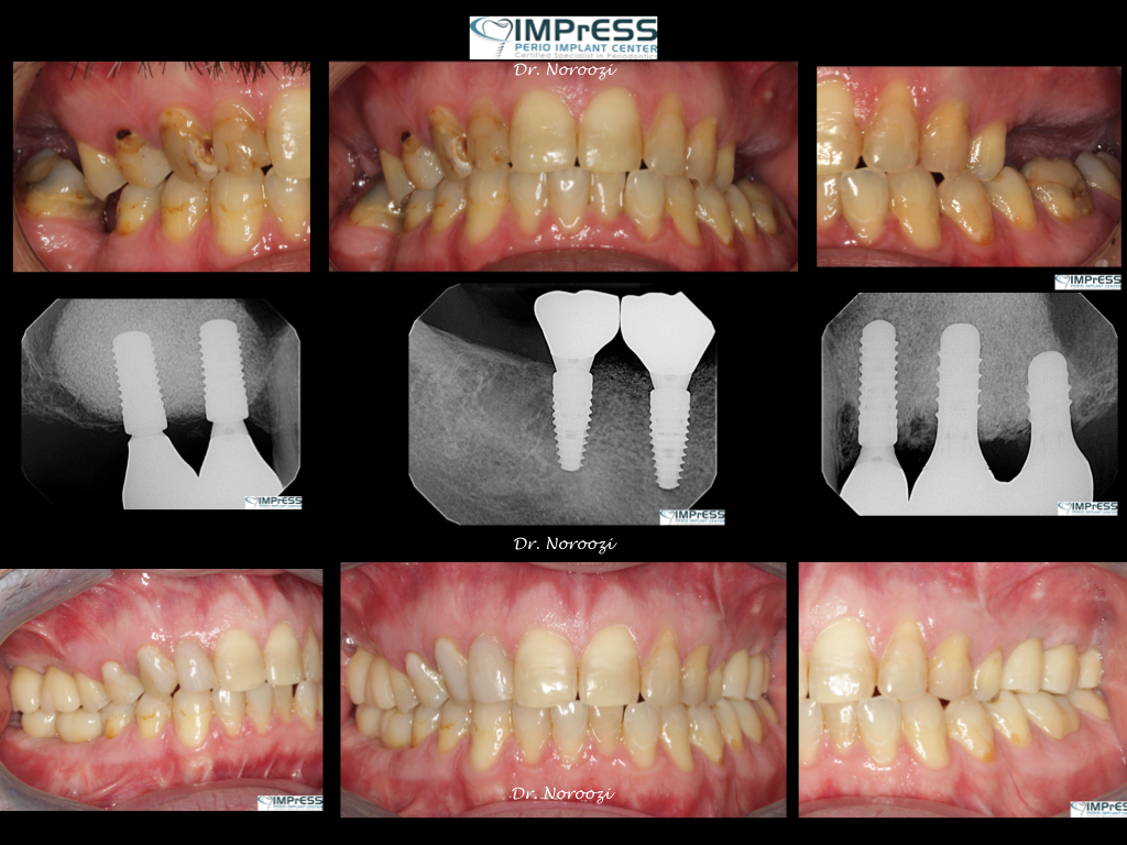 Dental Implant Centre in Vancouver Burnaby Sinus Lift Dental implant Surgery Dr. Noroozi Implant Specialist IMPrESS Perio Implant Center.001