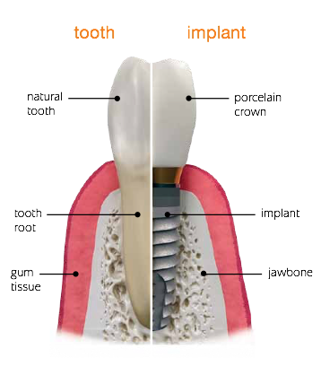 IMPreSS Perio Vancouver Burnaby Implant Dentist Specialist Dr. Noroozi