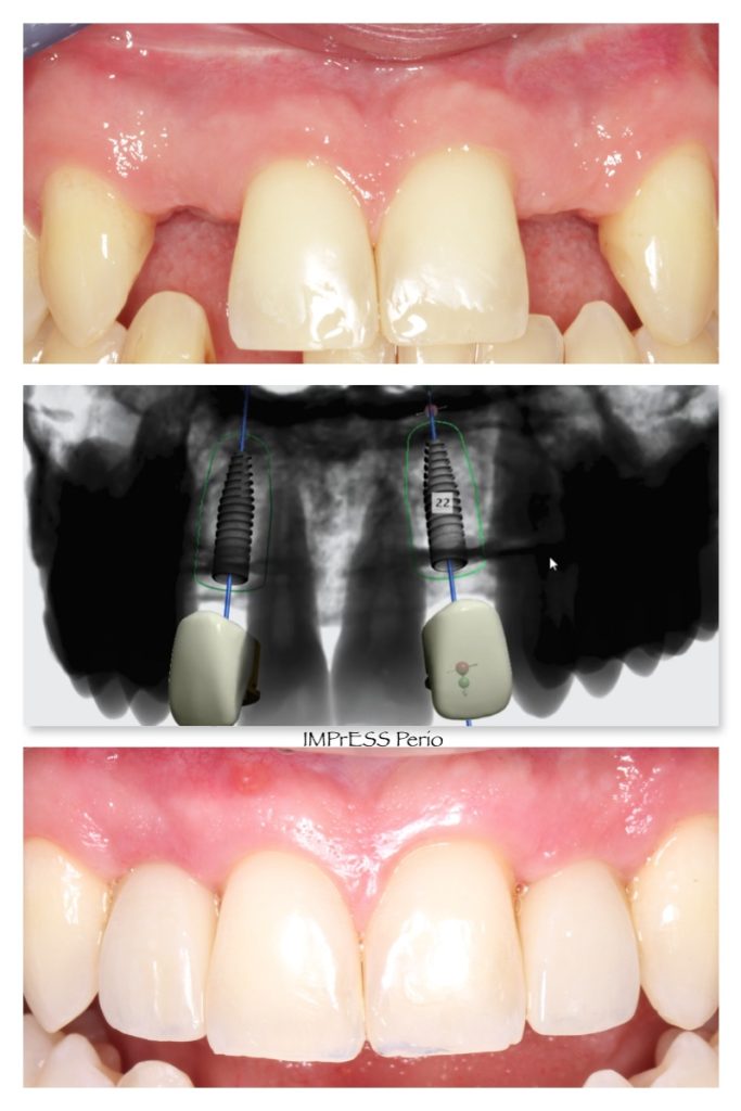 Congenitally missing teeth replacement with dental implants IMPrESS Perio Implant Center