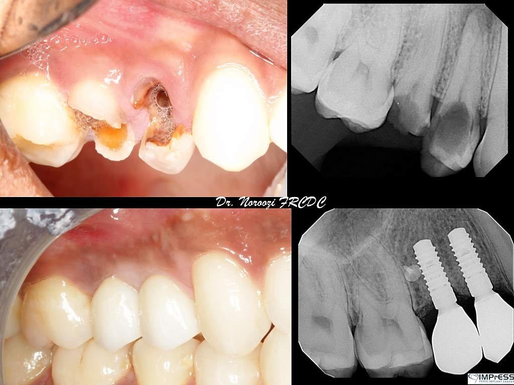 Dental Implants in Burnaby BC Vancouver BC IMPrESS Perio Implant Center