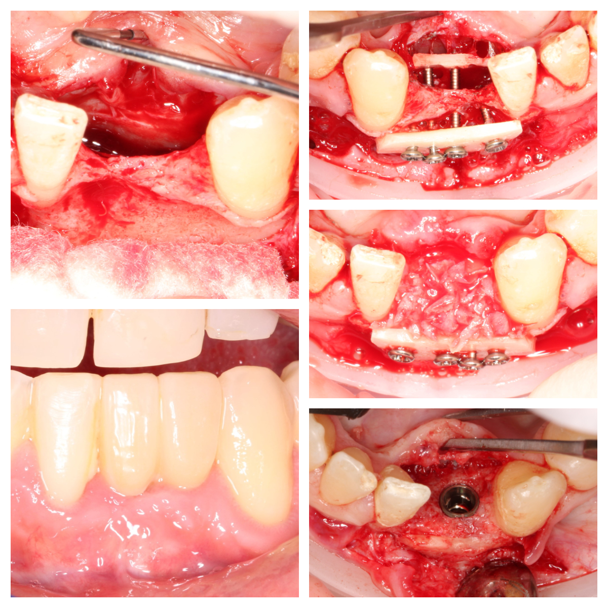 Dr Noroozi IMPrESS Perio Implant Center Bone Grafting for Dental Implants Khoury Technique