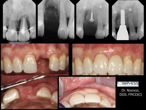 Vancouver Best Implant Dentist Bone Graft Front Tooth Implant Best Dental Implant Centre Vancouver BC