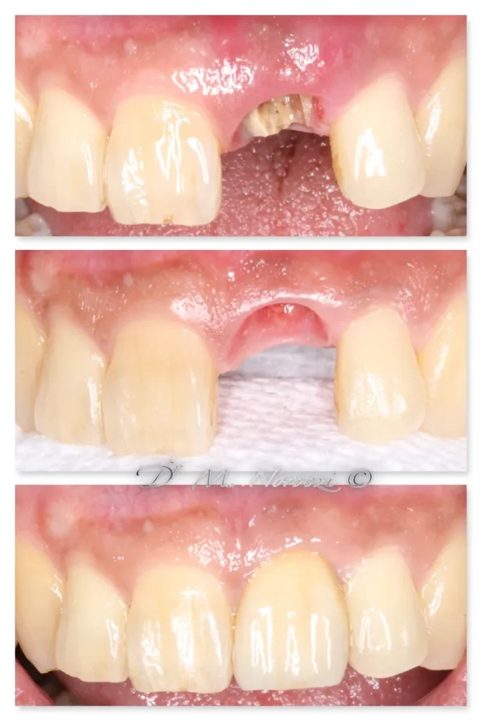 Front Implant Tooth Dr. Mehdi Noroozi IMPrESS Perio Implant Center Vancouver Burnaby Periodontist Implant Specialist
