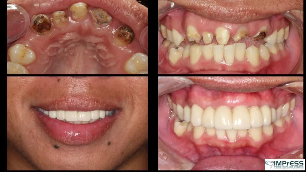 Front Teeth Dental Implant Bridge by Vancouver Dr. Noroozi Implant Specialist