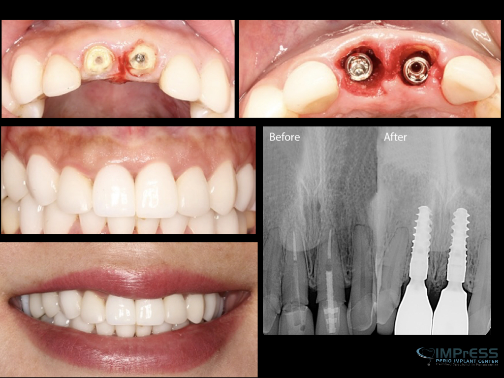 IMPrESS Perio Immediate upper front implants with partial extraction therapy, guided surgery and provisional and final crowns