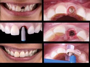 Immediate Implant and Crown, Same-day implant teeth Vancouver Burnaby BC