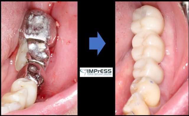 before and after of implant bridge in Vancouver