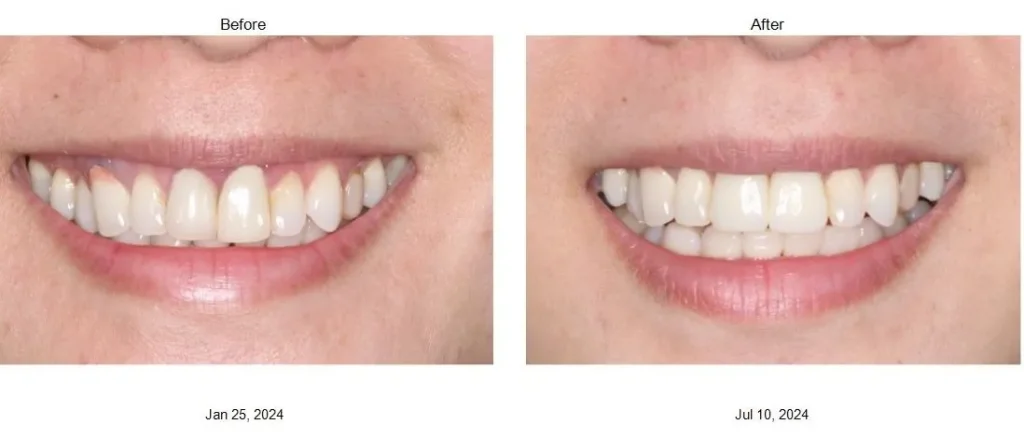 Front Teeth Dental Implants in Vancouver