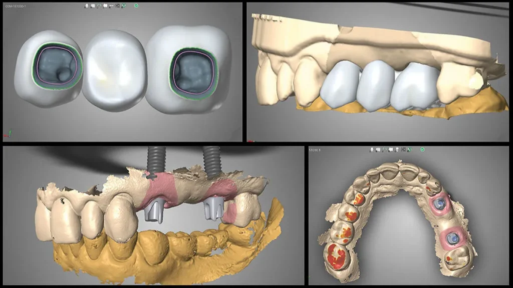 Digital Implant Dentistry in Burnaby BC, IMPrESS Perio Implant Center