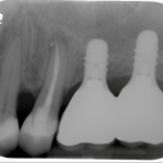 Sinus Lift implant Burnaby Periodontist IMPrESS Perio Implant