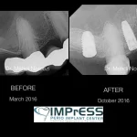 Dr. Noroozi Sinus Lift Surgery For Dental Implants IMPrESS Perio Implant Center