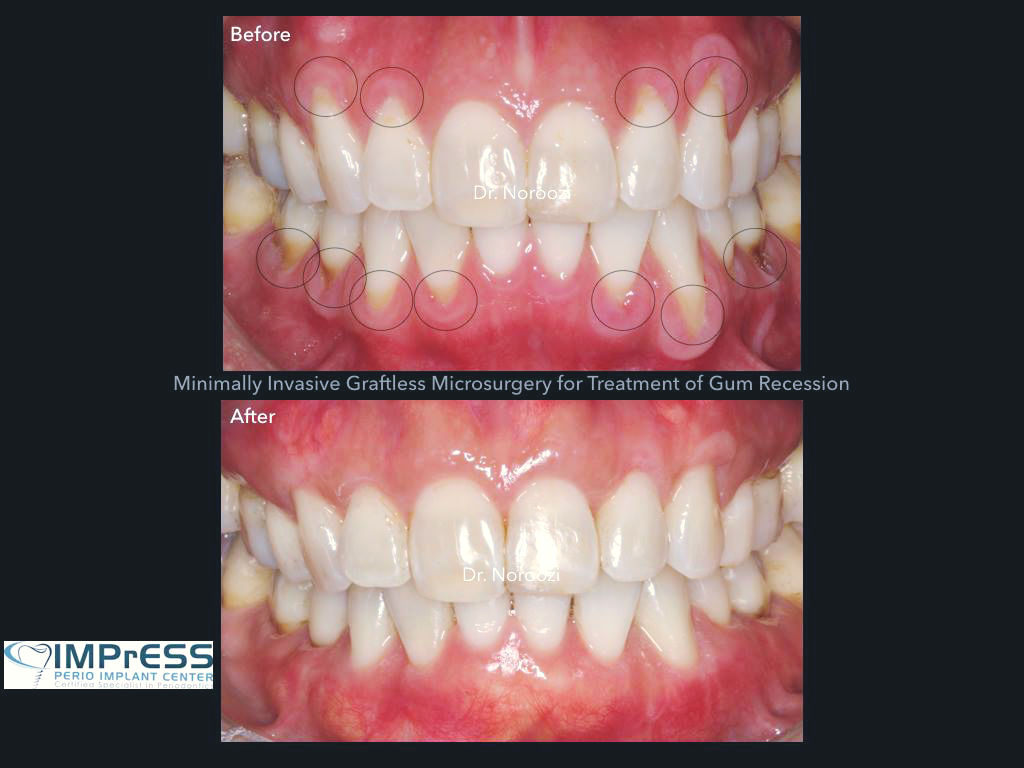 Gum Graft Alternative Gum Recession Treatment Alloderm Pinhole Surgical technique Vancouver BC Noroozi