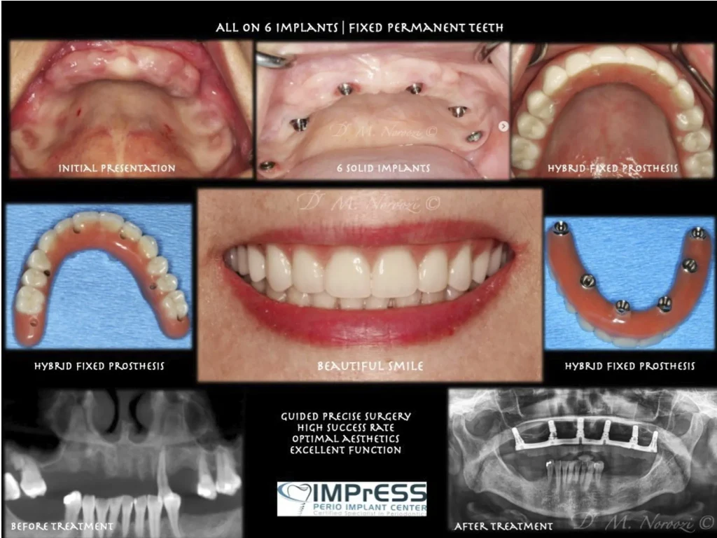 IMPrESS Perio Implant Center Dr. Noroozi Vancouver Periodontist Implant Specialist Burnaby BC