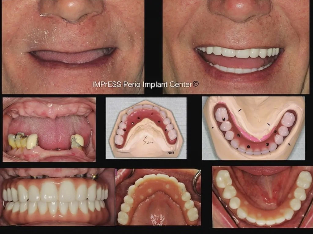 IMPrESS Perio Implant Center Dr. Noroozi Vancouver Periodontist Implant Specialist Burnaby BC