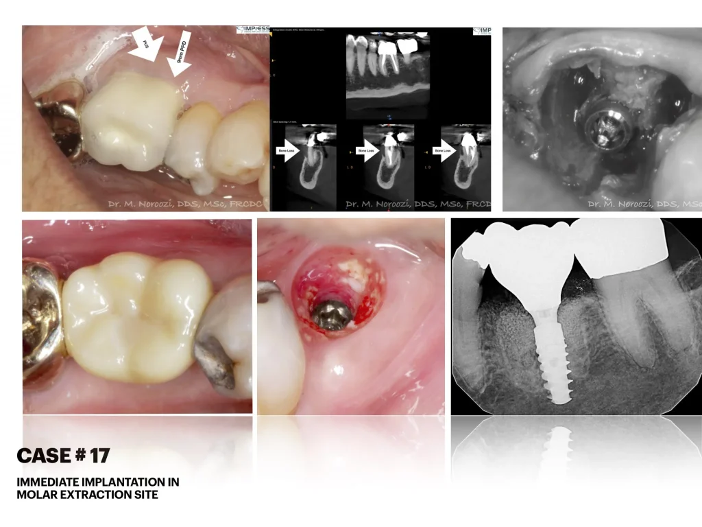 IMPrESS Perio Implant Center Dr. Noroozi Vancouver Periodontist Implant Specialist Burnaby BC