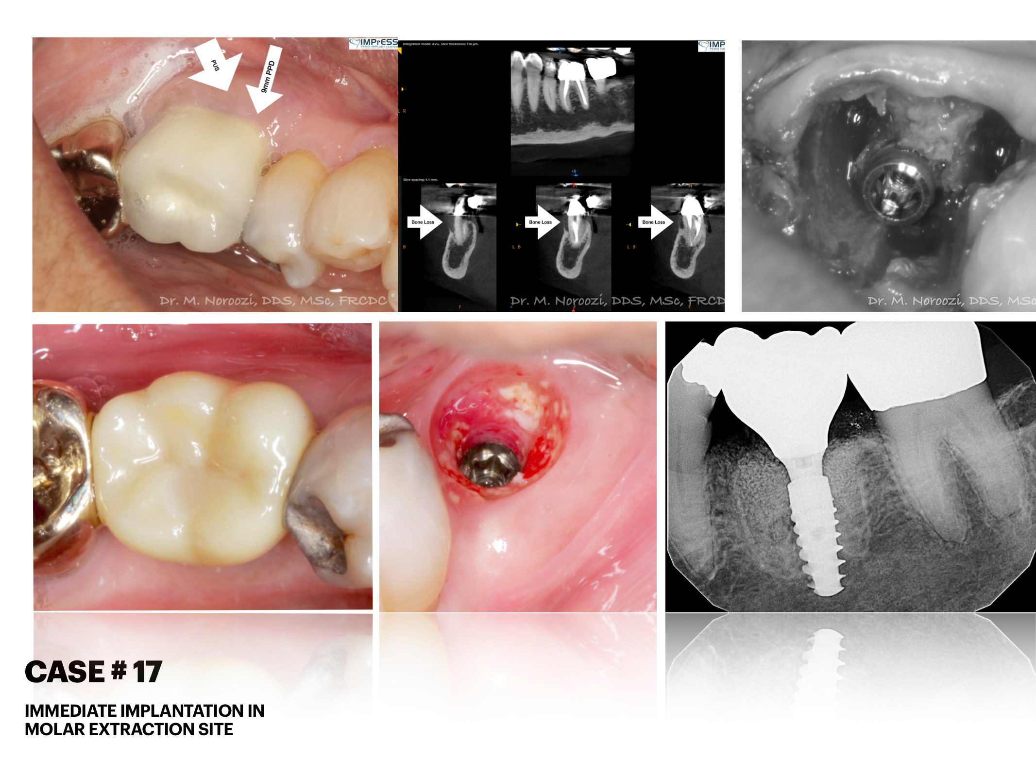 IMPrESS Perio Implant Center Dr. Noroozi Vancouver Periodontist Implant Specialist Burnaby BC