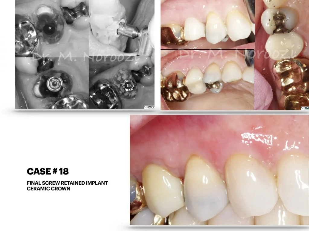 IMPrESS Perio Implant Center Dr. Noroozi Vancouver Periodontist Implant Specialist Burnaby BC