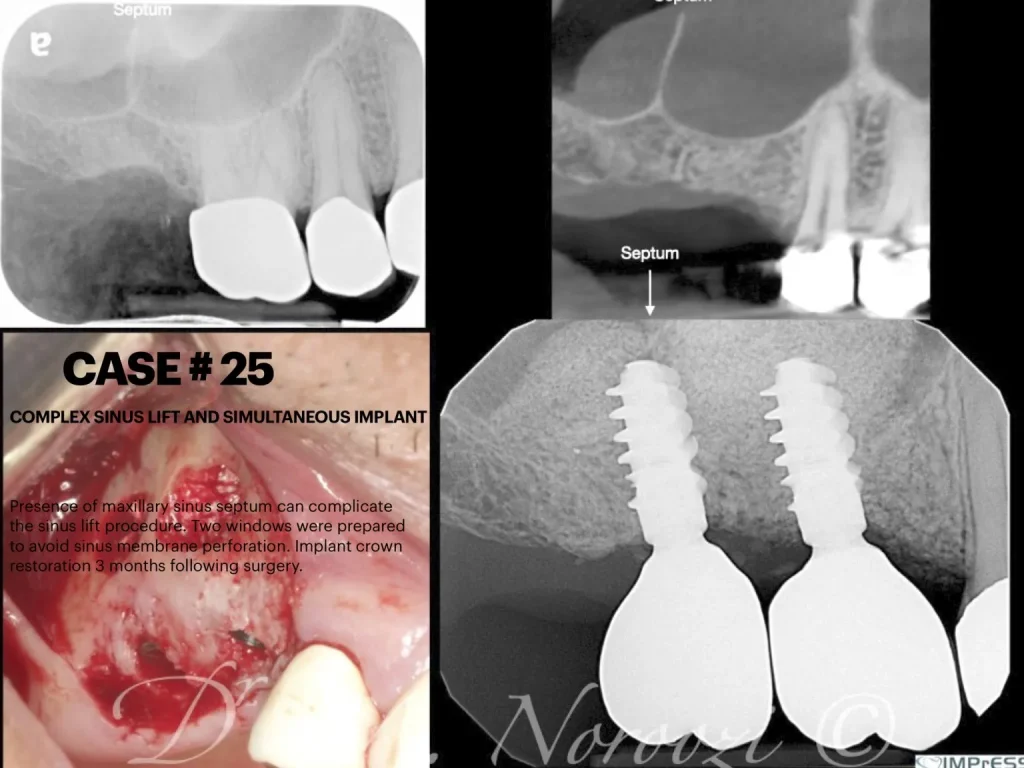 IMPrESS Perio Implant Center Dr. Noroozi Vancouver Periodontist Implant Specialist Burnaby BC