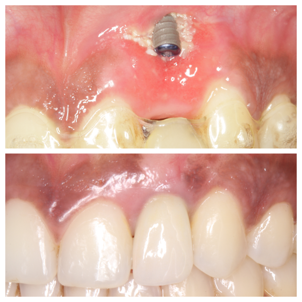 Implant Complication Management