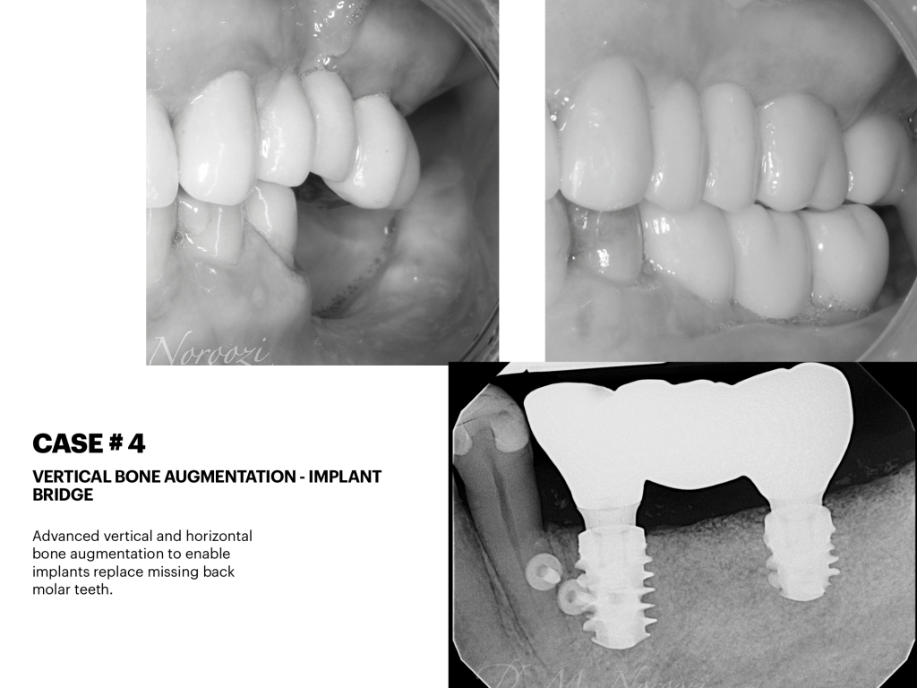Dr. Noroozi IMPrESS Perio Implant Center Vancouver and Burnaby Advanced Centre for Periodontics and Implant Dentistry