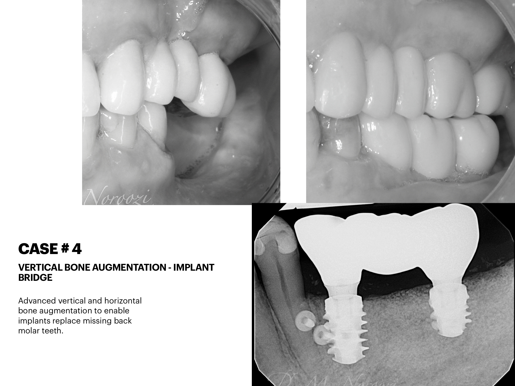 Dr. Noroozi IMPrESS Perio Implant Center Vancouver and Burnaby Advanced Centre for Periodontics and Implant Dentistry