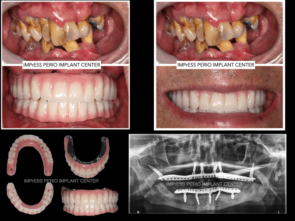 All On X Full Mouth Implants Fixed Teeth IMPrESS Perio Implant Centre Dr Noroozi Burnaby Vancouver BC