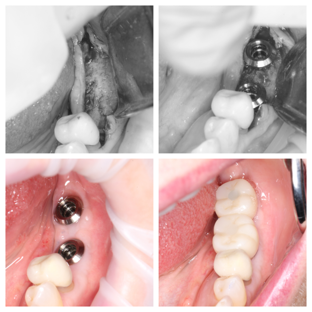 Bone Graft Implants Dr Noroozi IMPRESS Perio Implant Center