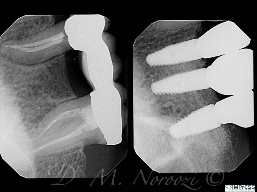 Bone Grafting for implants Guided Implant Surgery Implant Bridge Dr. Noroozi Vancouver Implant Specialist IMPrESS Perio Implant Center