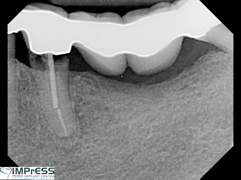 Dr. Noroozi IMPrESS Perio Implant Center Vancouver and Burnaby Advanced Centre for Periodontics and Implant Dentistry