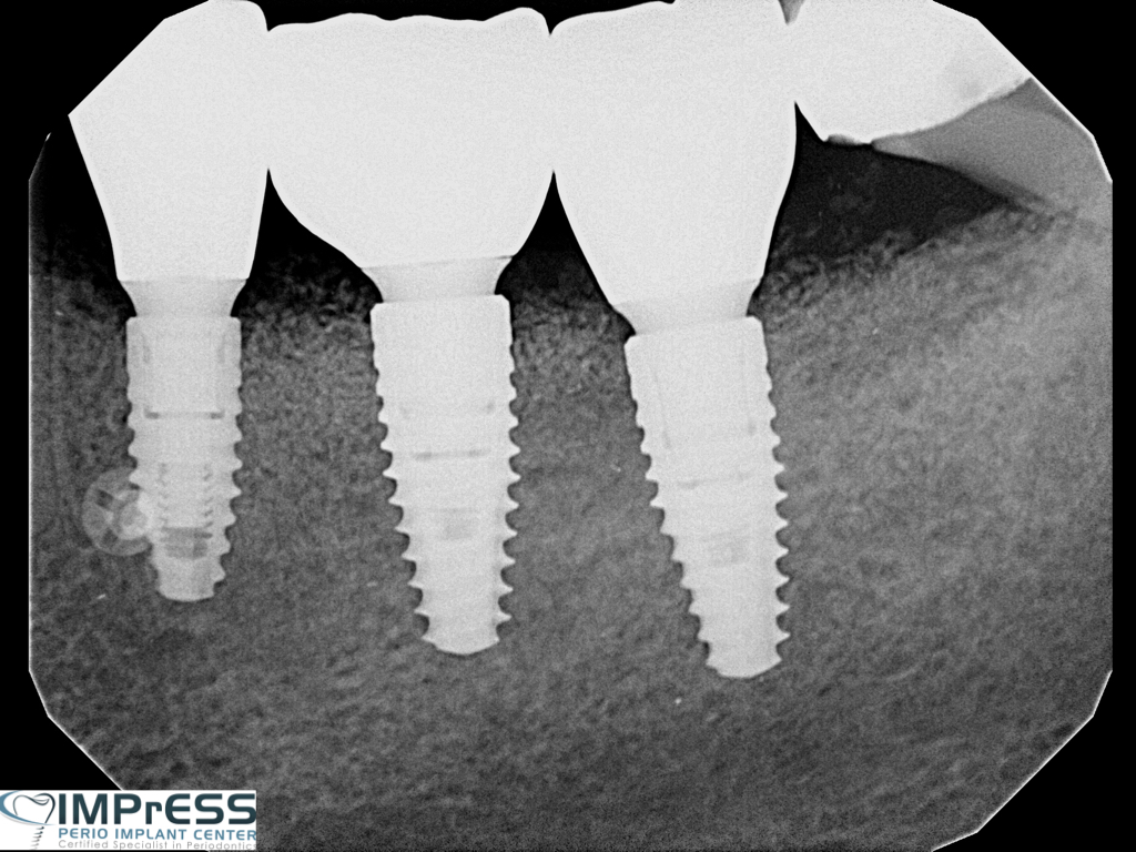 Dr. Noroozi IMPrESS Perio Implant Center Vancouver and Burnaby Advanced Centre for Periodontics and Implant Dentistry