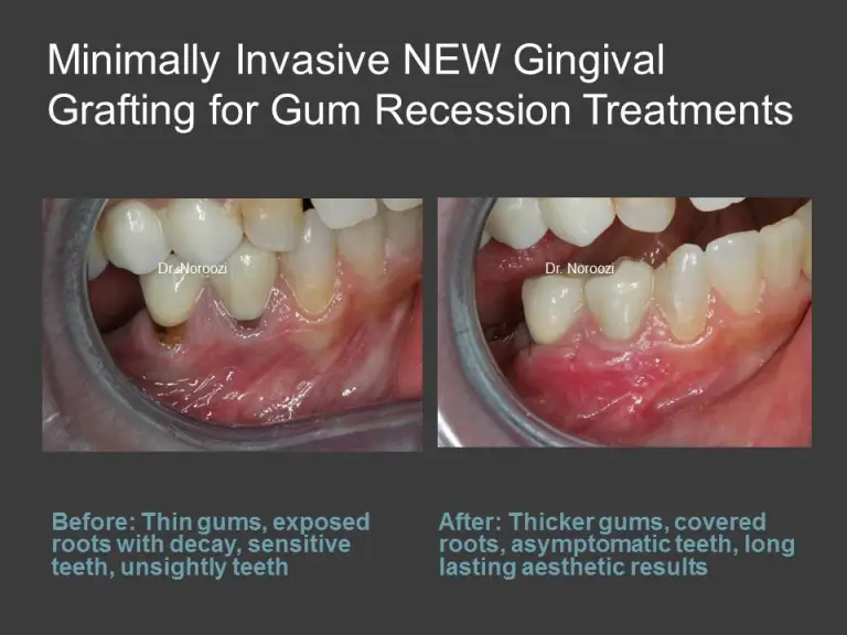 dental gum graft in vancouver bc gum recession treatment vancouver bc periodontist best gum graft dentist