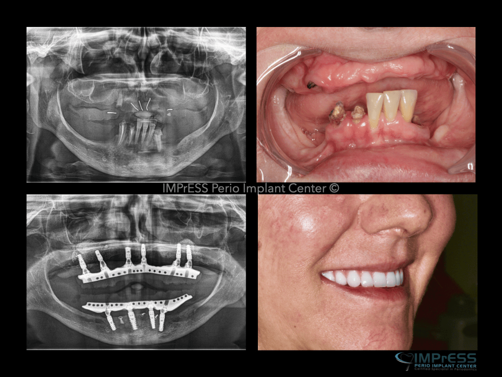 Full Mouth Implant Rehabilitation IMPrESS Perio Implant Center Dr. Noroozi implant Specialist Burnaby Vancouver BC