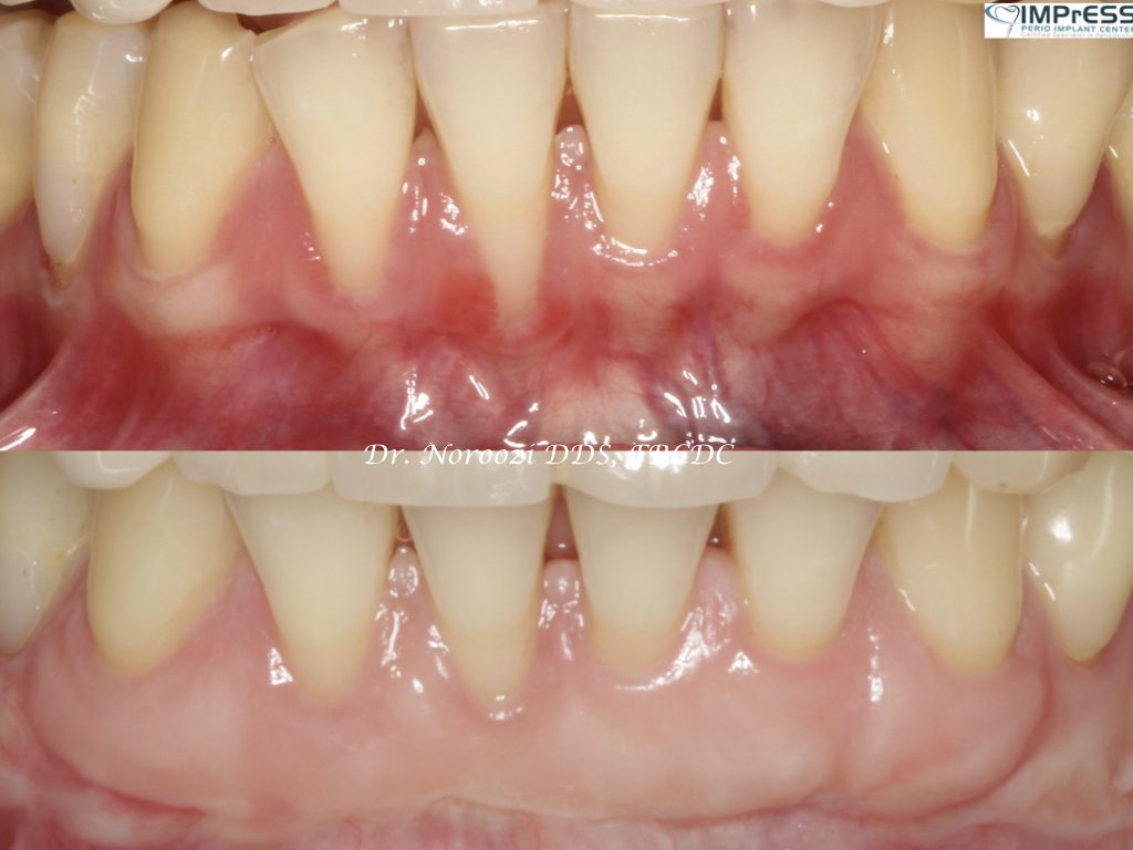 Gingival Graft Best Gum Graft for gum recession treatment Vancouver Burnaby Periodontist Dr. Noroozi IMPrESS Perio Implant Center.001