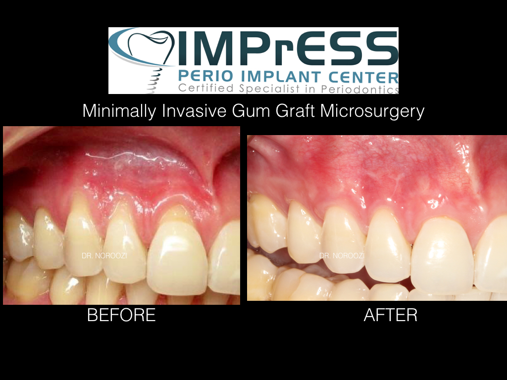 Best gum graft in Vancouver Burnaby Dr. Noroozi Periodontist