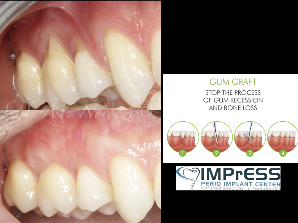 Gum Recession Treatment Gum Graft in Vancouver BC Burnaby BC Dr. Noroozi Periodontist IMPrESS Perio Implant Center