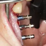 Burnaby Periodontist Bunraby Sinus lift IMPrESS Perio Implant Dr. Noroozi