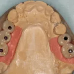 Burnaby Periodontist Bunraby Sinus lift IMPrESS Perio Implant Dr. Noroozi