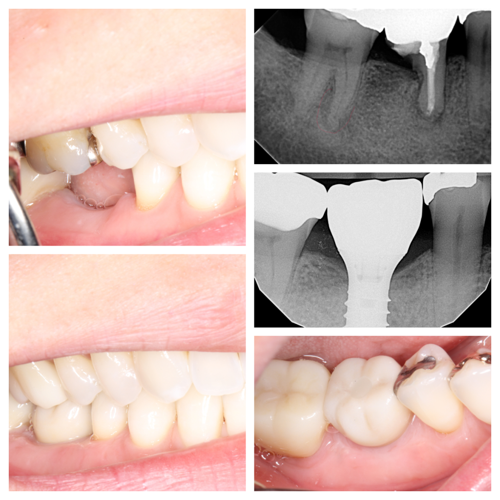 Implant Tooth IMPRESS Perio Implant Center Burnaby Dental Clinic