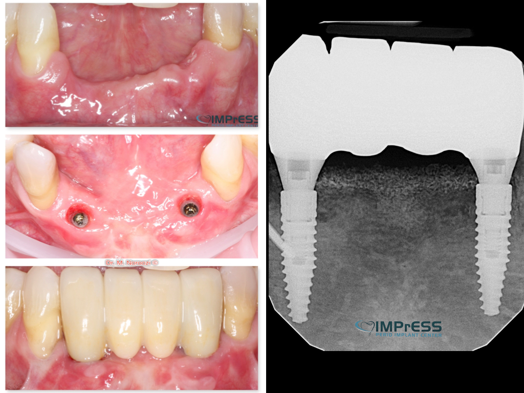 Implant dentistry bone and soft tissue grafting IMPrESS Perio Implant Center Dr. Mehdi Noroozi Implant Specialist Vancouver Burnaby BC
