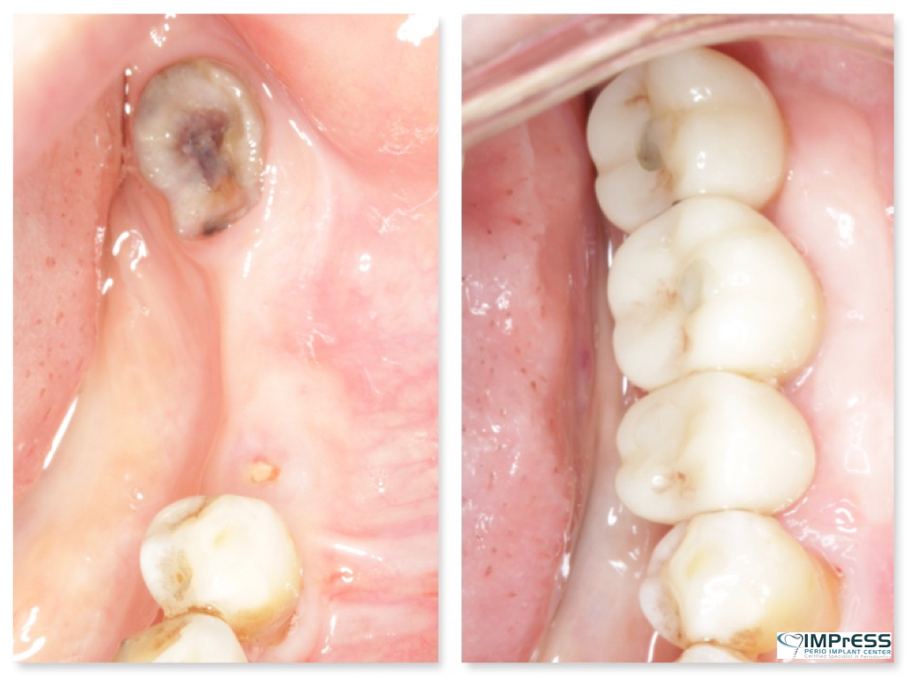 Replacing Missing Teeth with Implants at IMPrESS Perio