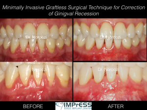 Pinhole Surgical Technique Gum Graft Alternative for treatment of Gum recession IMPrESS Perio Dr. Noroozi