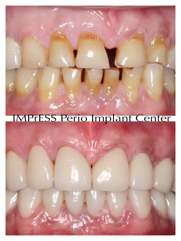 Porcelain Veneers By Burnaby Prosthodontist IMPrESS Perio Implant Center