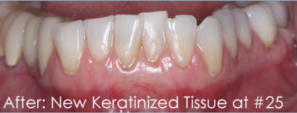 Pinhole Gum Rejuvenation Dr. Mehdi Noroozi Burnaby Periodontist IMPrESS Perio Implant Center