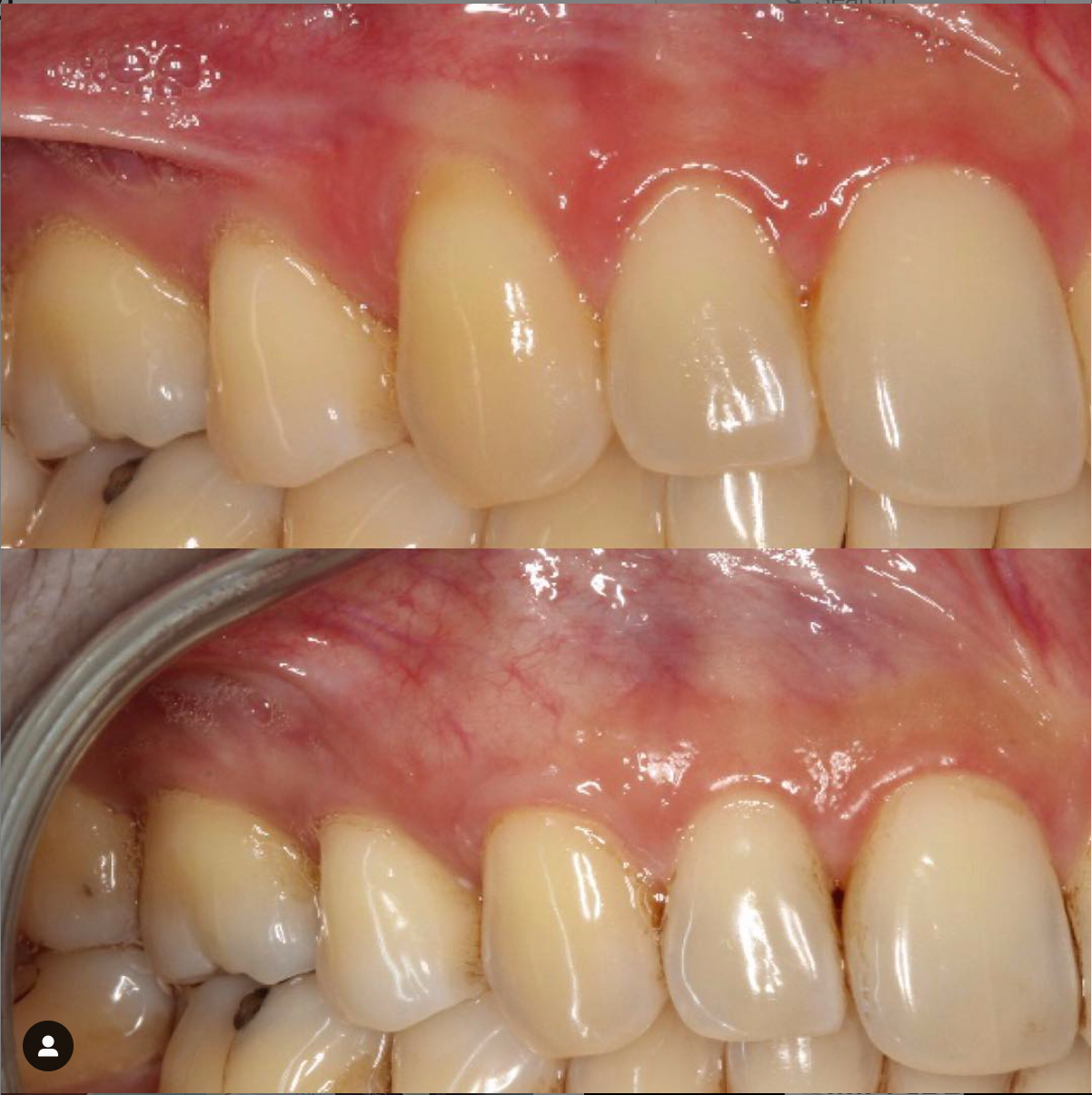 Gum recession treatment in Burnaby BC near Vancouver Best Periodontist Dr. Noroozi IMPrESS Perio Implant Center