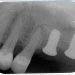 Burnaby Periodontist Sinus lift dental implants implant dentist